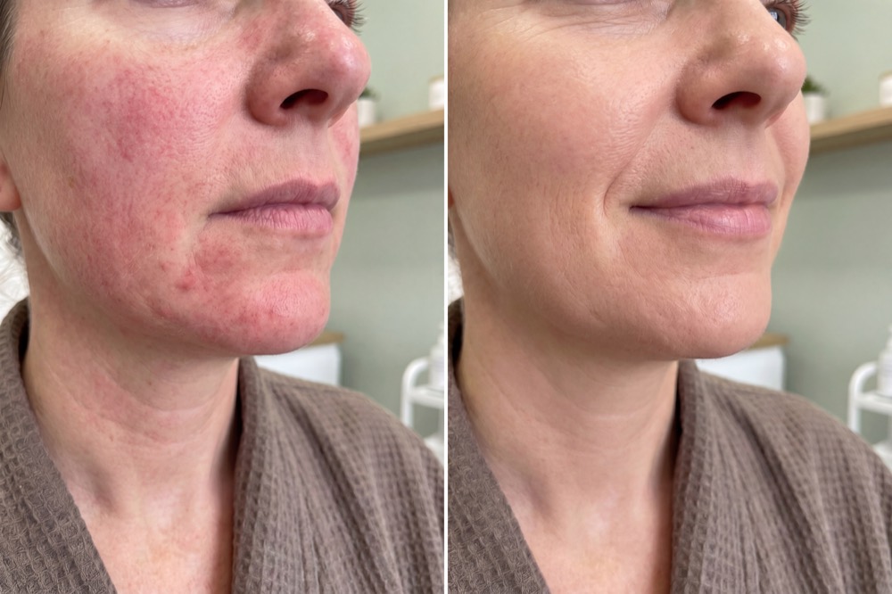 Before and after skin results